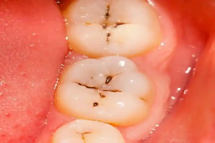 可乐龋齿多指可乐中的酸性物质破坏牙齿,进而引发龋齿,龋齿最初只涉及