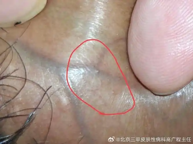 慢,醋酸白阴性,激光去除后隔几个月可能又复发,是不是考虑鲍温样丘疹?