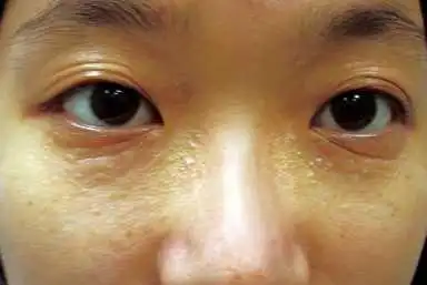 汗管瘤的预防及护理