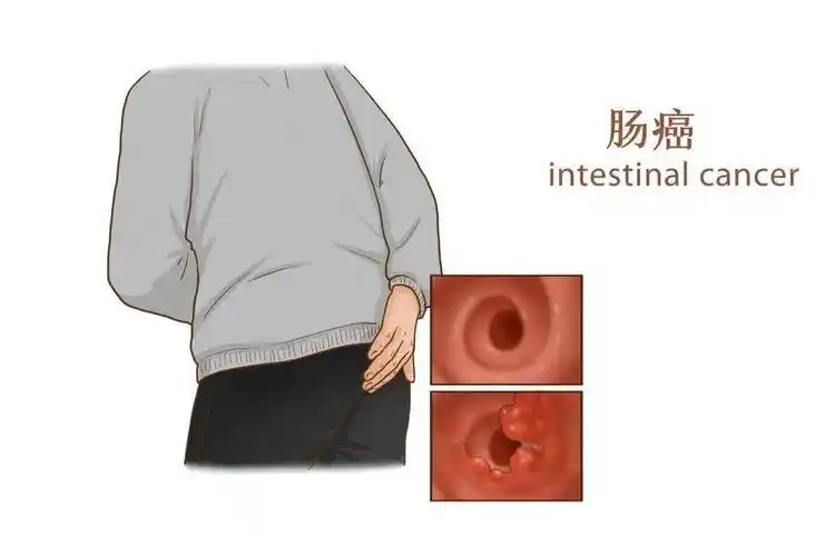 【医学篇】肠癌有什么表现?_症状