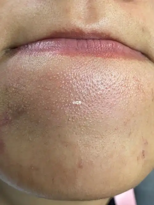 看我下巴这密密麻麻的闭口小红书还能信吗