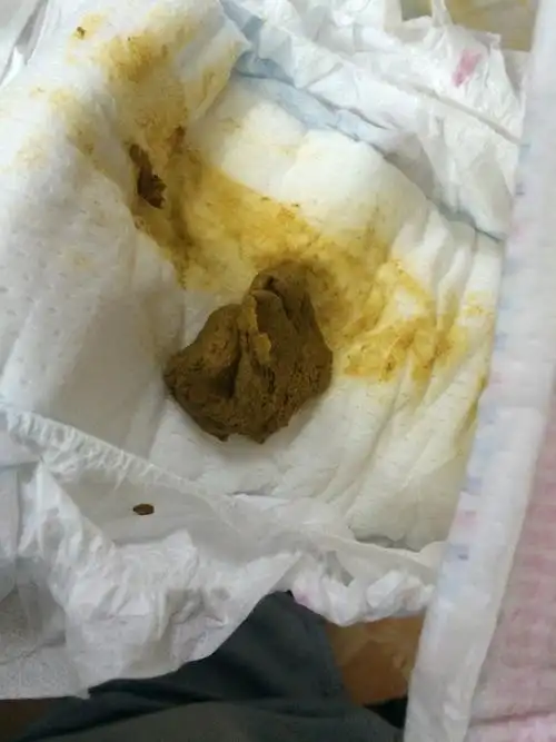 期间给吃了香蕉和橙子,今天拉的粑粑像大人的一样,是便秘导致