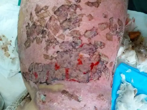 这是植皮术后第10天.