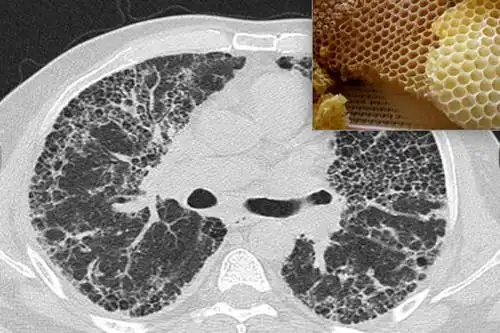 六旬老伯患病全家人庆幸不是肺癌可为何最终老人走得更快
