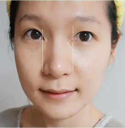 鼻头又肉又大,打肉毒素就能缩小