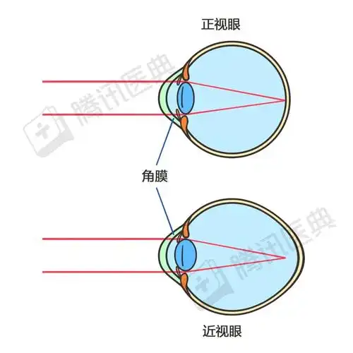这是正常的眼睛与近视眼睛(轴性近视,绝大多数的近视类型)对比图