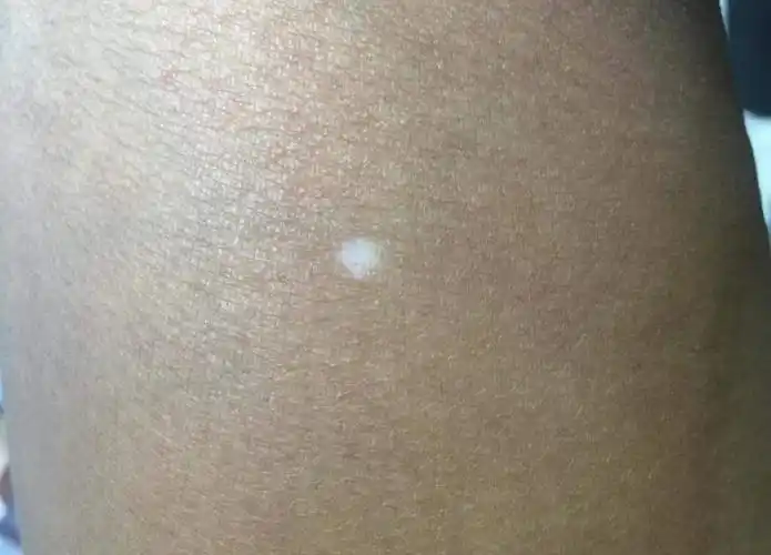 身上的这些小白点不是白癜风,有可能是皮肤衰老的表现_白斑