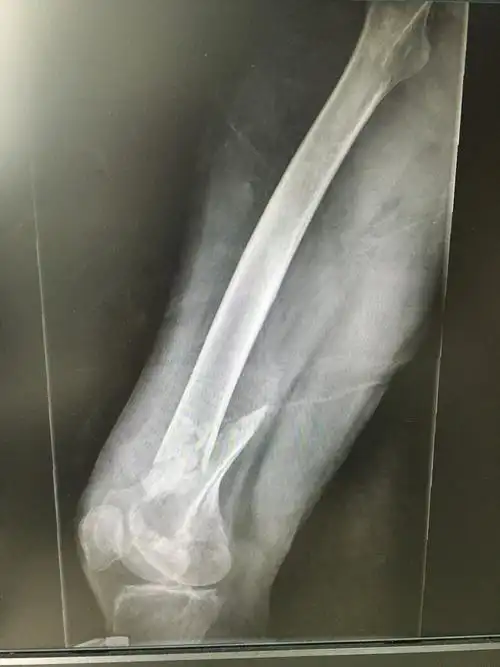 股骨远端骨折:考验医生的手术 - 好大夫在线