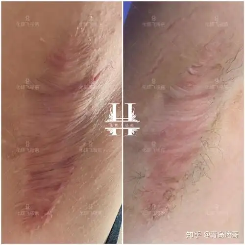 非常严重的腋下手术疤痕 - 知乎