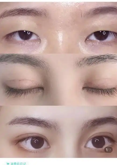 双眼皮前后对比照片