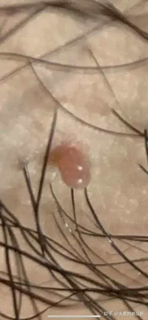 胳肢窝下面十几厘米处长了个小肉粒,今天洗澡发现的,不疼不痒,可以