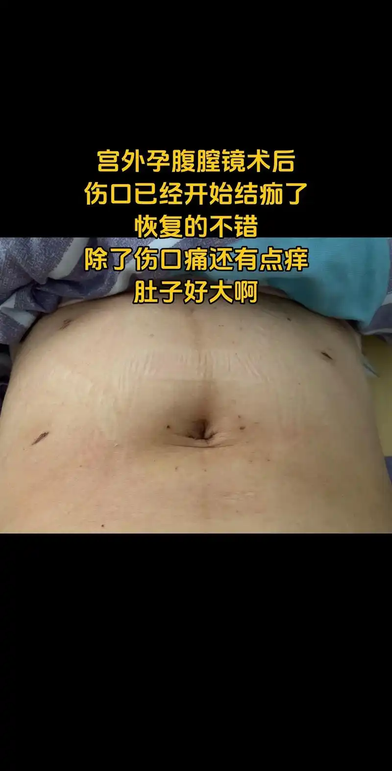 宫外孕腹腔镜术后出院回家修养 肚子好大