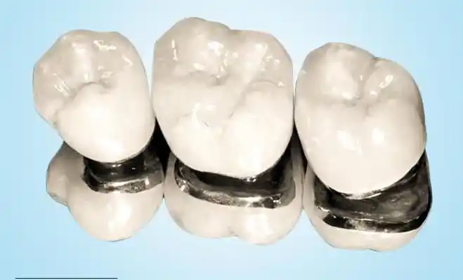 镶一颗钴铬牙需多少价格?一篇文章解决你所有疑惑!_ip138媒体号