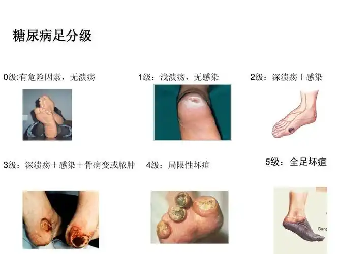 所有分类 高等教育 医学 内科护理学课件-糖尿病ppt 糖尿病足分级 0