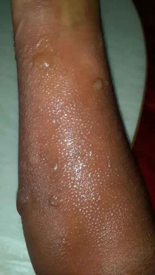 胳膊让开水烫了.用什么药膏才会好的快.并且不落疤?