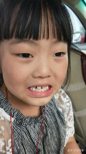 部分小孩子在在换牙过程中,会暂时性牙齿排列不整齐;六岁恒牙开始萌出