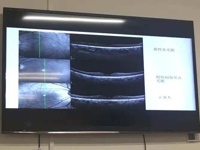 oct和octa在青光眼的应用-肖辉