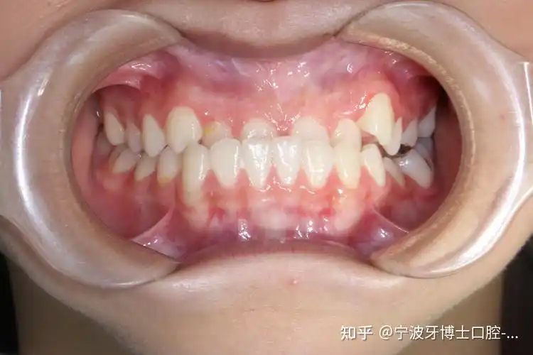 下巴会"兜出来",所以反颌也俗称地包天或者兜齿