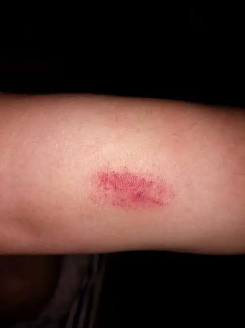 请问这是什么虫子?被咬到像针扎一样,咬后的部位瞬间乌一大片