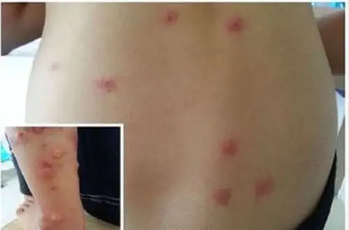 丘疹性荨麻疹状图片大全