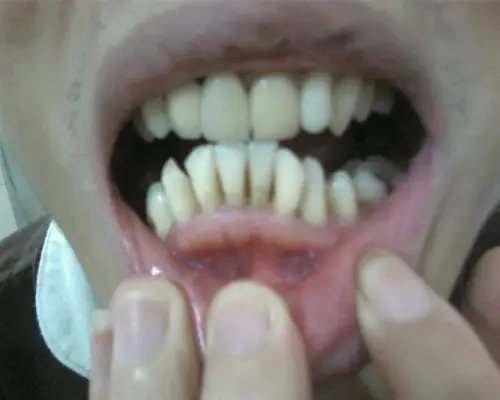 牙龈突起太多,是否正常