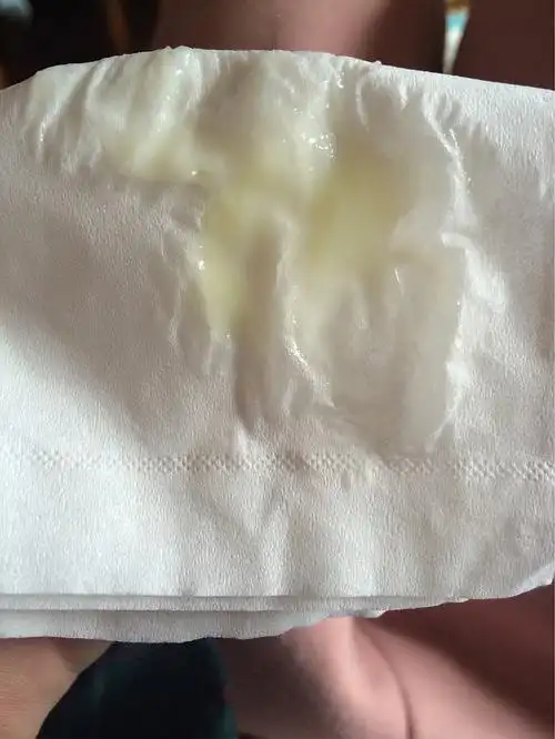 我几年前得过霉菌阴道炎 没及时治疗 自此之后 白带都是黄绿色脓状 量