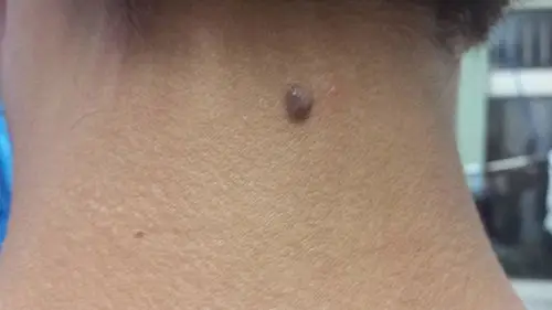 黑痣有皮内痣(位于真皮层,稍突或乳头状凸起,有时带有汗毛,最多见)