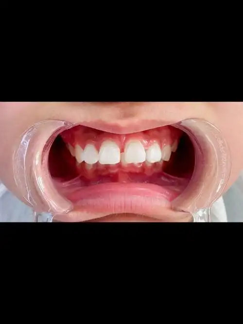 一年半以前龅牙的小朋友嘴唇都合不上,经过一年半的努力 今天终于拆除