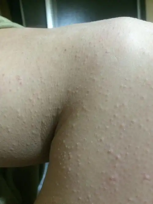 身上起小疙瘩像粉刺不痛不痒以前没有过这种症状