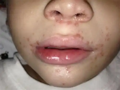 大人患口蹄疫症状