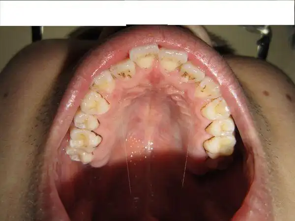 上颚两颗门牙后面的牙肉肿了