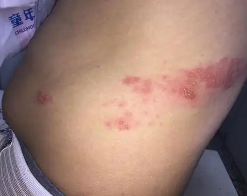 带状疱疹又称之为转腰龙,蛇盘疮,以沿着神经阶段分布的群集水泡伴有