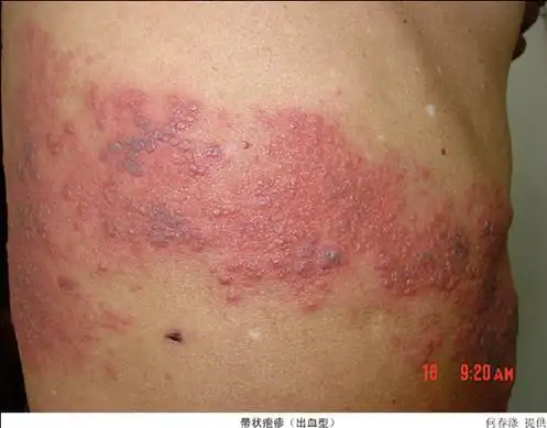 飞蛇病会传染吗为什么会得飞蛇病如何治疗飞蛇病