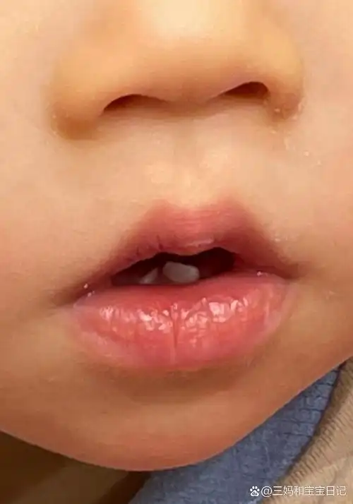 宝宝嘴唇干裂?