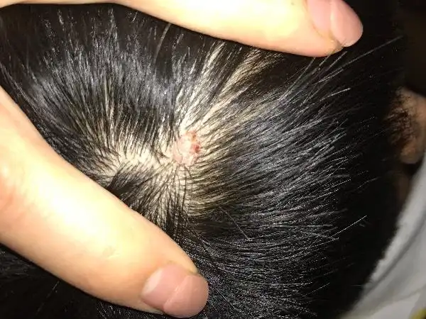 请问头上长了这样一个鼓起来的包怎么办?之前没那么大的结果用手抠