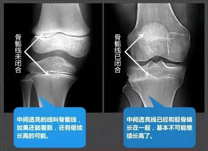 骨骺线,就是关节部位,骨骼末端的干骺端与骨骺之间的一条线,如果我们