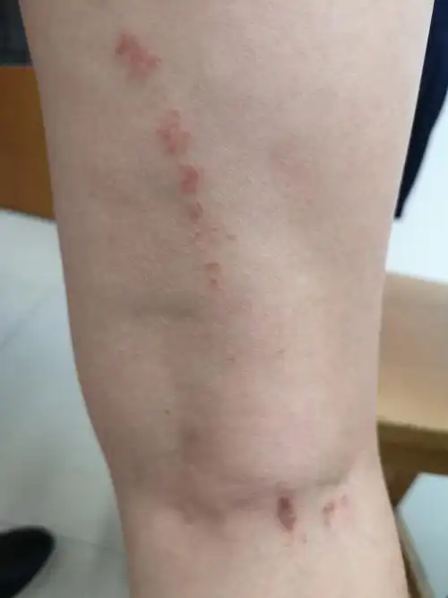 扁平苔藓变形记