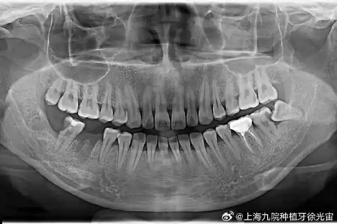 局部牙片一般能拍到三颗牙齿,在医生需要观察单颗牙齿时会用到这种