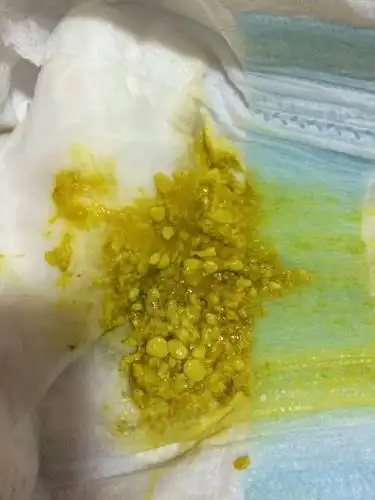 出生两周的婴儿的大便为颗粒状,请问是生病了吗? - 百度宝宝知道