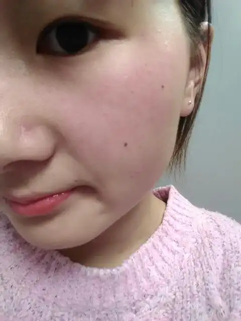 皮肤角质层薄,可以修复吗,或者怎么增厚角质层.