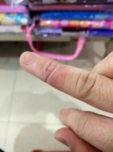 手被火碱烧了怎么办.