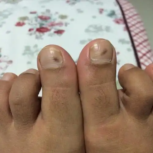 医生解析灰指甲的病因_金华婺城皮肤病防治院【官网】