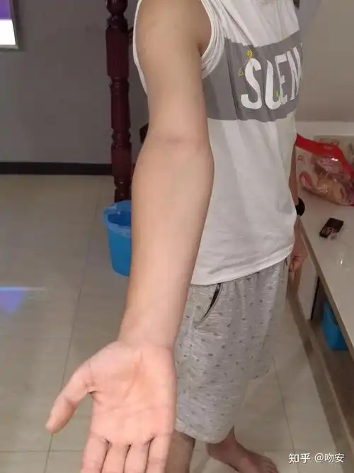 我想问一下我的这个算肘外翻吗?军检有没有问题?