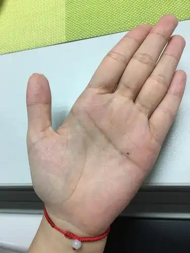 求解掌心长了一个痣