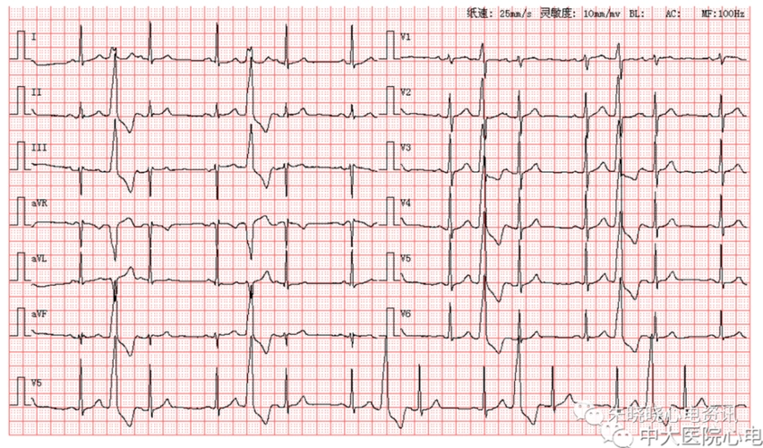 欢迎各位老师文章底部留言次日发送心电读图参考解析往期回顾