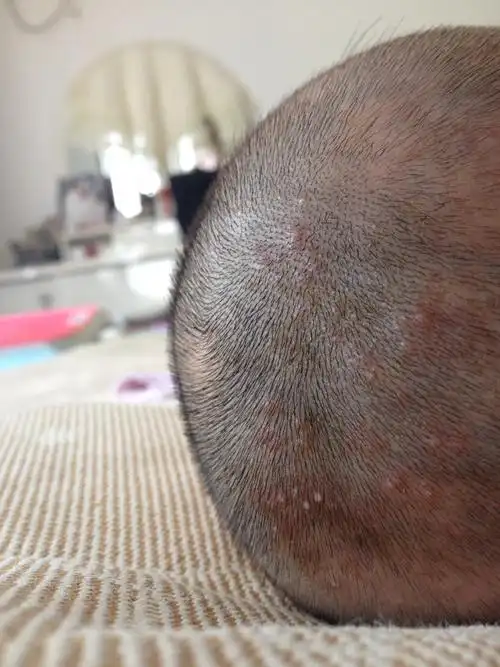 宝宝三个多月头上长的痘痘都有白点了,怎么办?
