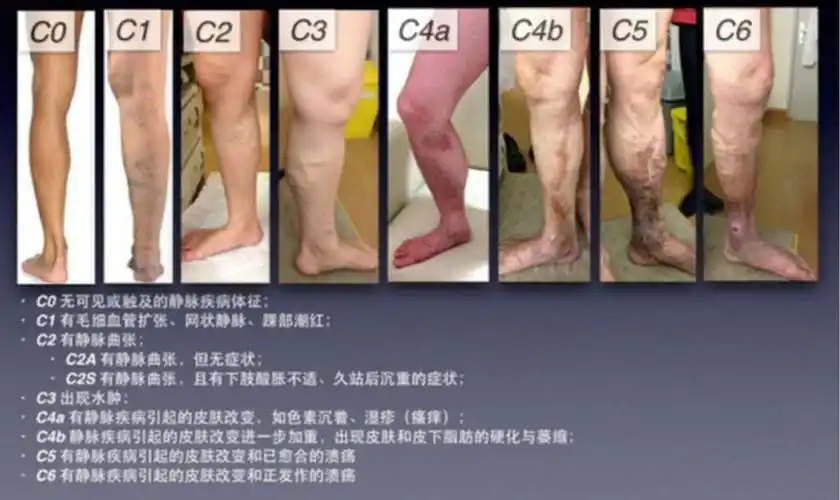 大隐静脉曲张分级