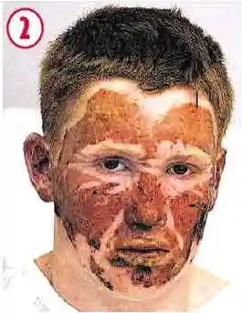 英国雀斑少年脸烧伤 治愈后脸部奇迹变帅(组图)