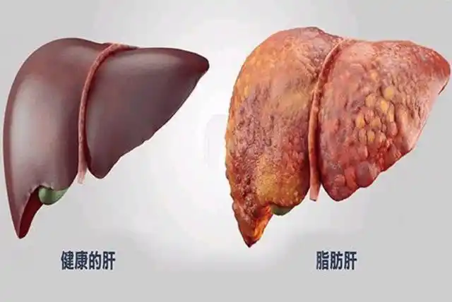脂肪肝讲简单一点就是说我们肝脏里面的脂肪太多了.