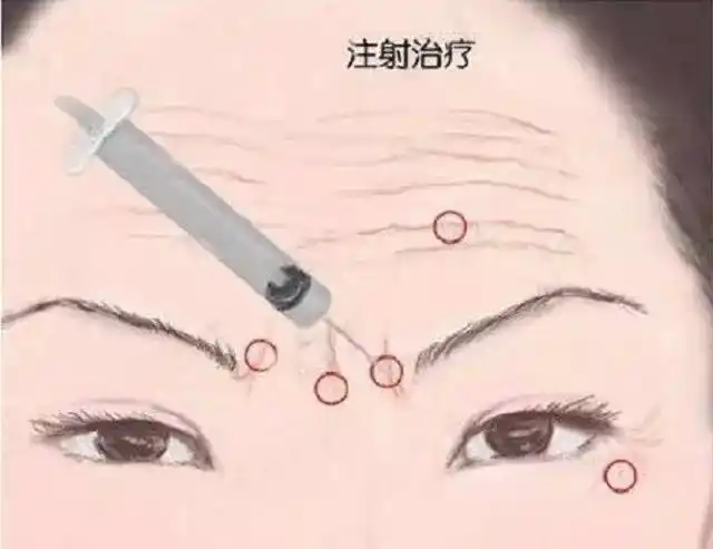 怎么去除眉间纹|肉毒素|肌肉|除皱_新浪女性_新浪网